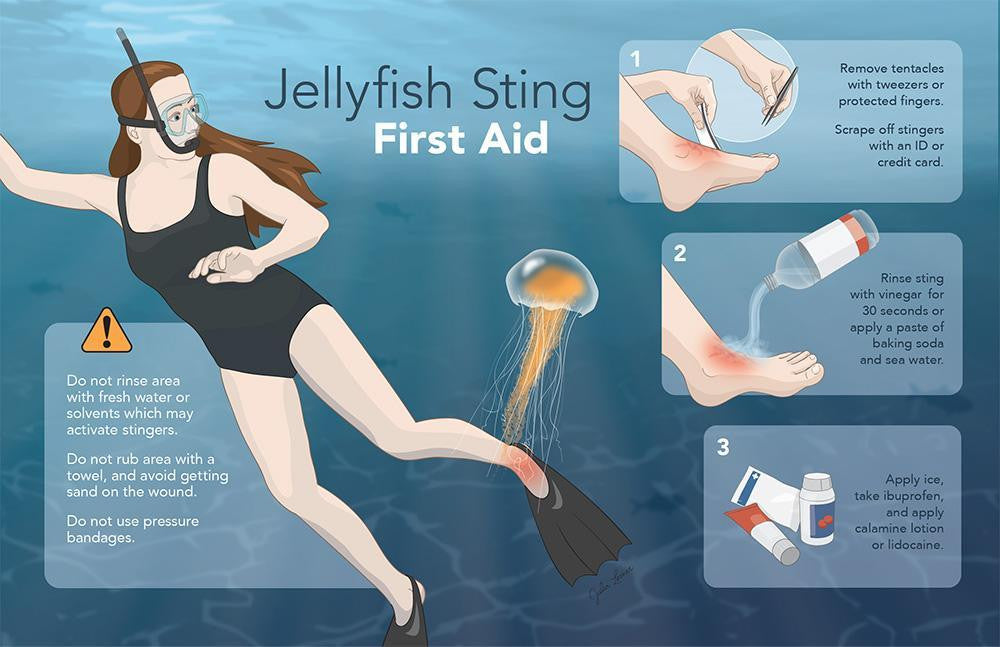 What to do if you are stung by a Jellyfish.